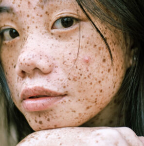 Cloesup of asian woman's face with acne