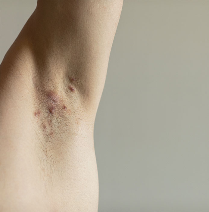 Image of hidradenitis suppurativa in armpit