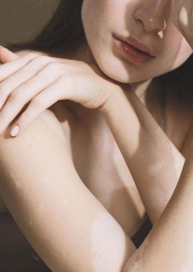 London based dermatologist - In the press - Woman with vitiligo