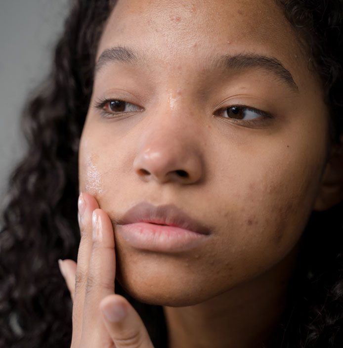 Young African-American woman with acne applying serum to her face