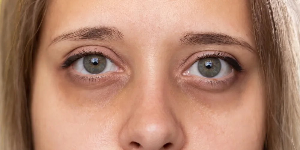What Causes Dark Circles Under the Eyes - 5 reasons why