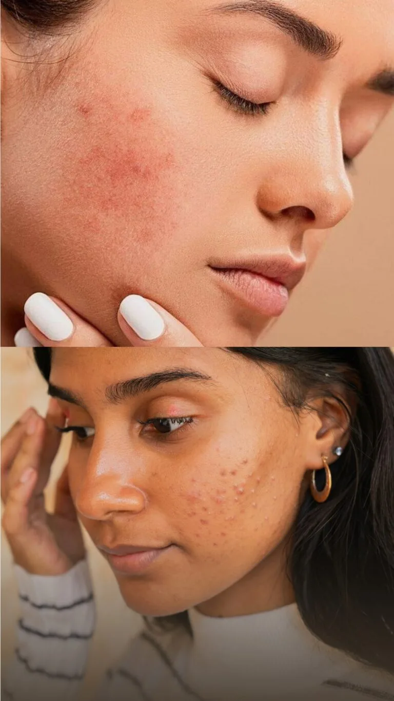 One woman with ance and another woman with rosacea