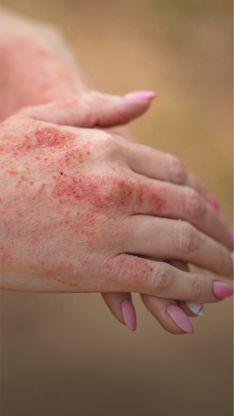 Person's with Allergic Contact Dermatitis hands