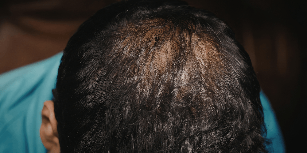 Minoxidil for Men - hairloss treatment