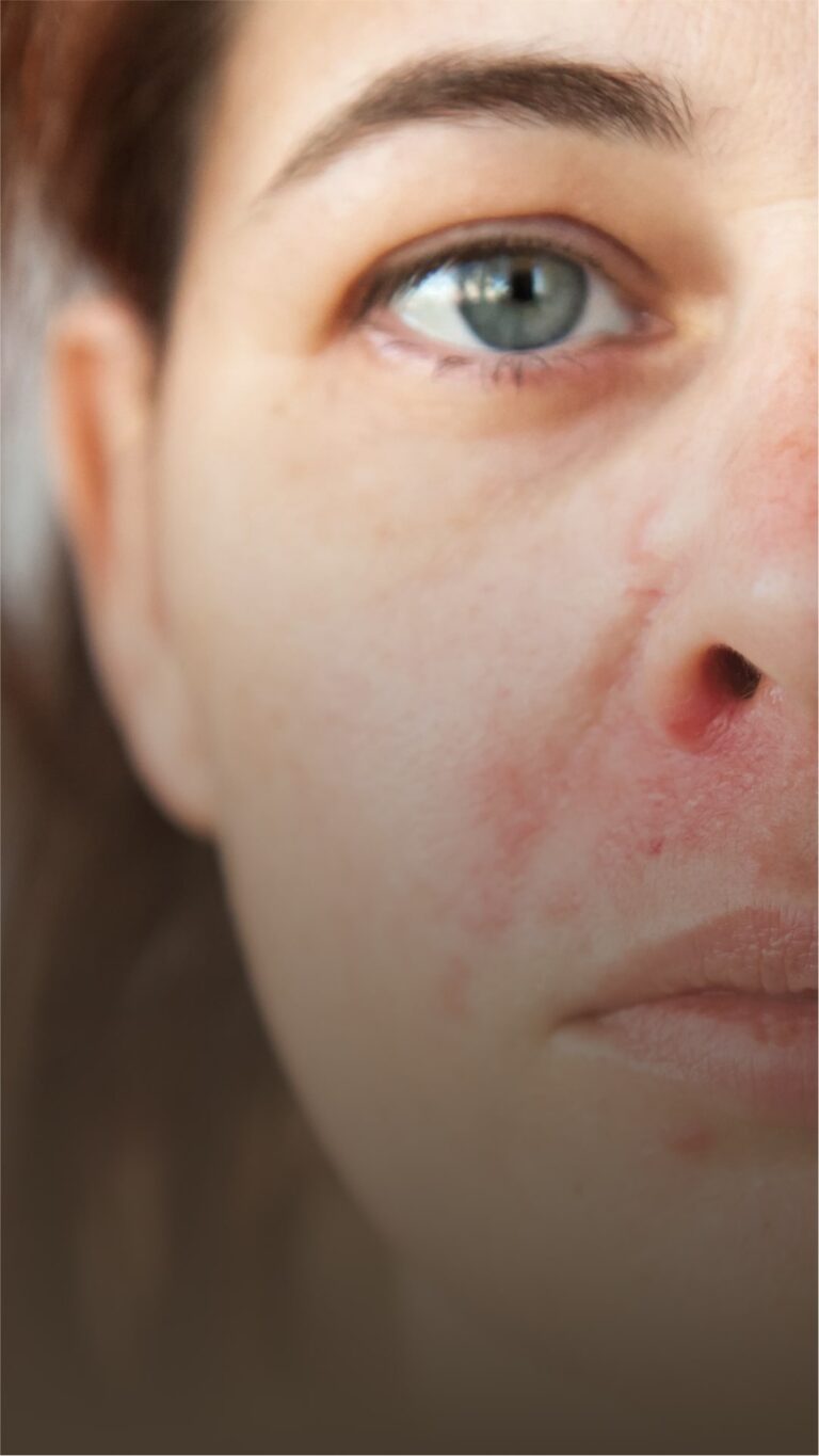 A woman with dermatitis