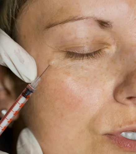 Polynucleotide injections for under eyes - dr derrick phillips