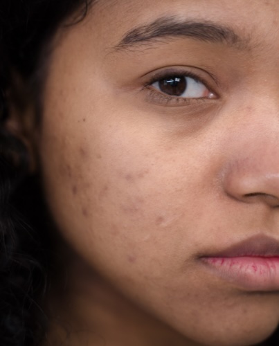 Post Inflammatory Hyperpigmentation dermatologist in london, uk