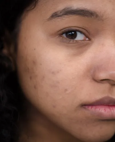 Post Inflammatory Hyperpigmentation dermatologist in london, uk