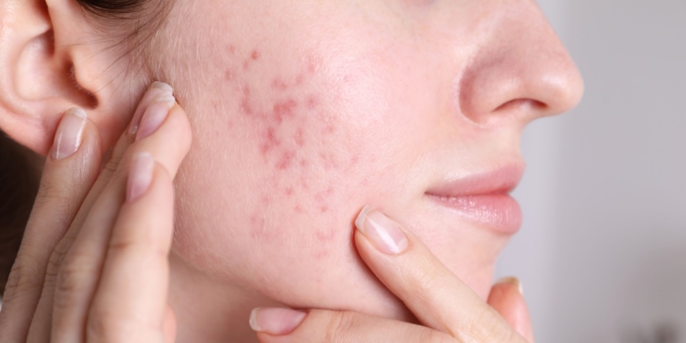 Post Inflammatory Hyperpigmentation Treatment - London, UK - dr derrick phillips