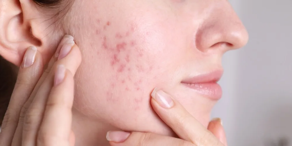 Post Inflammatory Hyperpigmentation Treatment - London, UK - dr derrick phillips