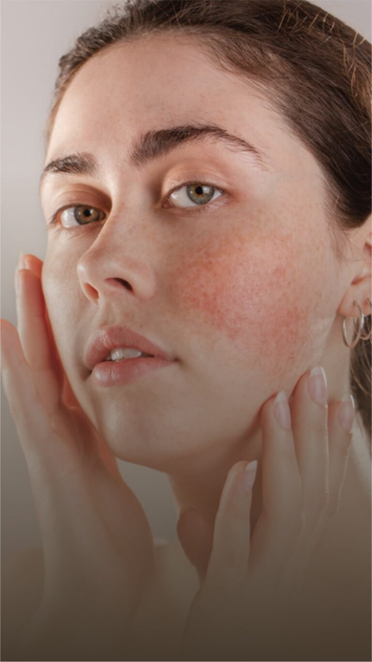 A closeup of a woman with Rosacea