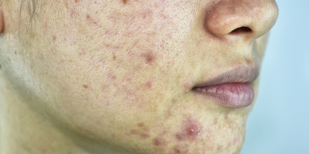 Spironolactone for Hormonal Acne - London, UK