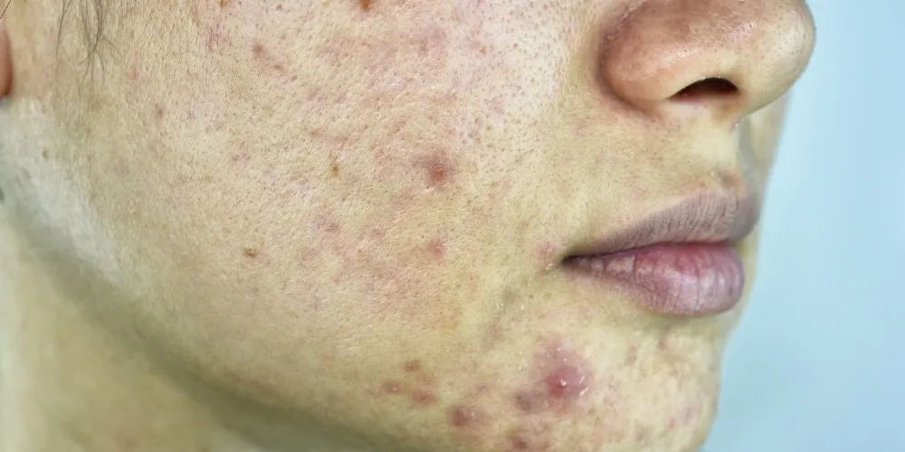 Spironolactone for Hormonal Acne - London, UK