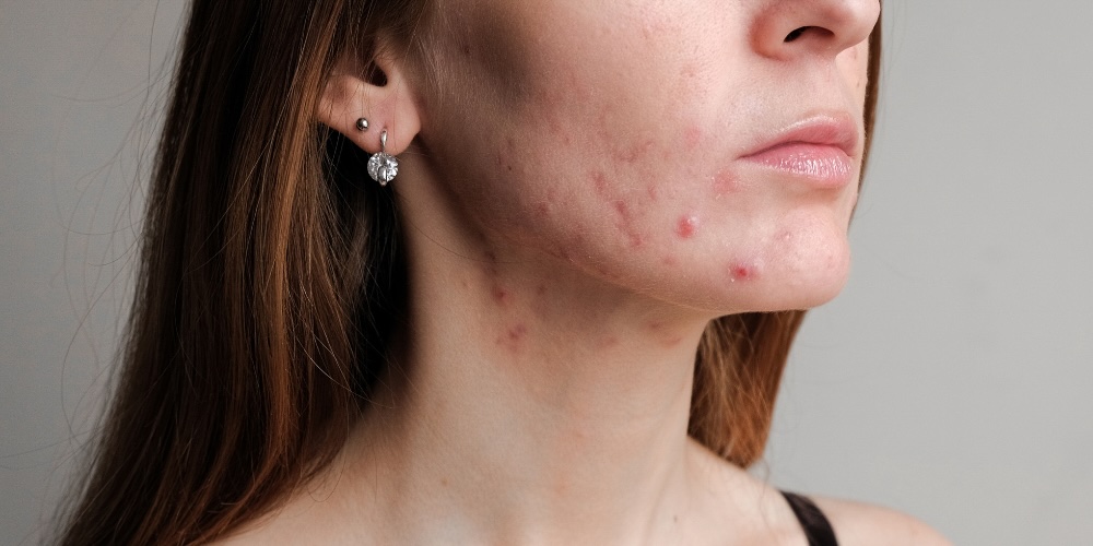 Spironolactone for Hormonal Acne -  Dr Derrick Phillips - London Dermatologist