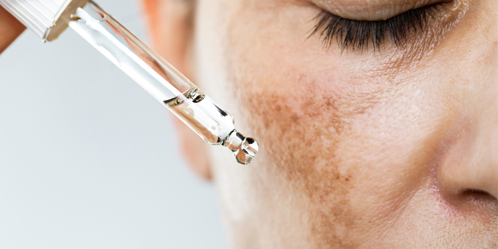 topical Tranexamic Acid for Melasma - london UK treatment