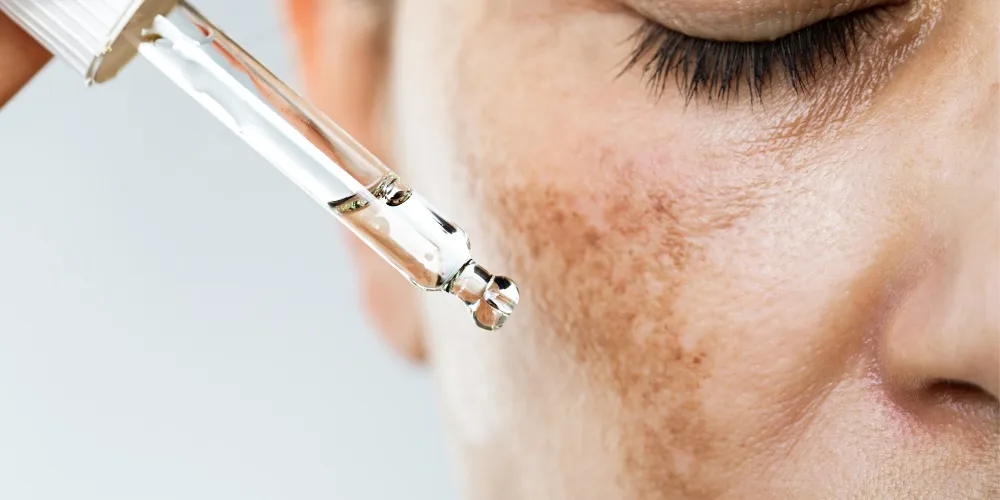 topical Tranexamic Acid for Melasma - london UK treatment