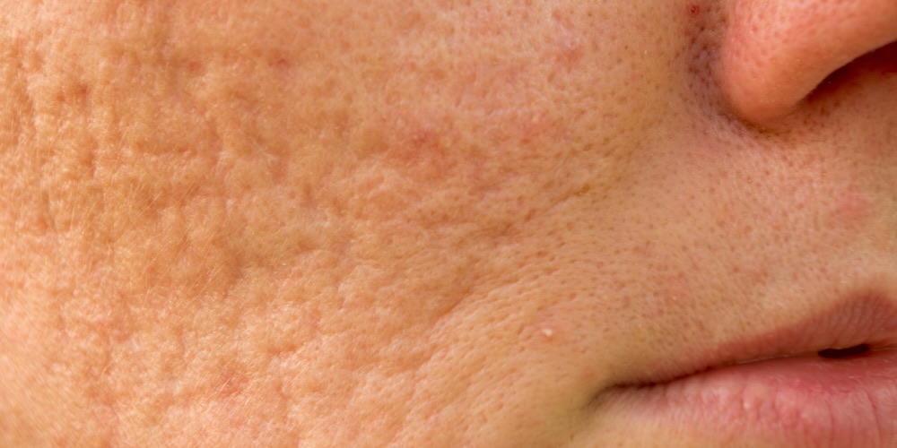 acne scar removal guide from london based dermatologist, dr derrick phillips