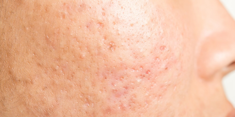 acne scar treatment in london - dr derrick phillips