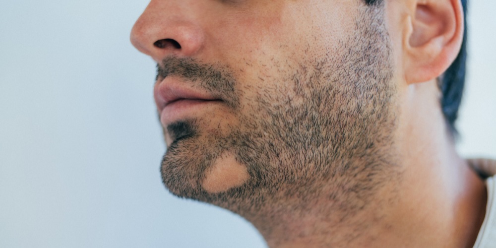 alopecia barbae - treamtnet for beard bald spots