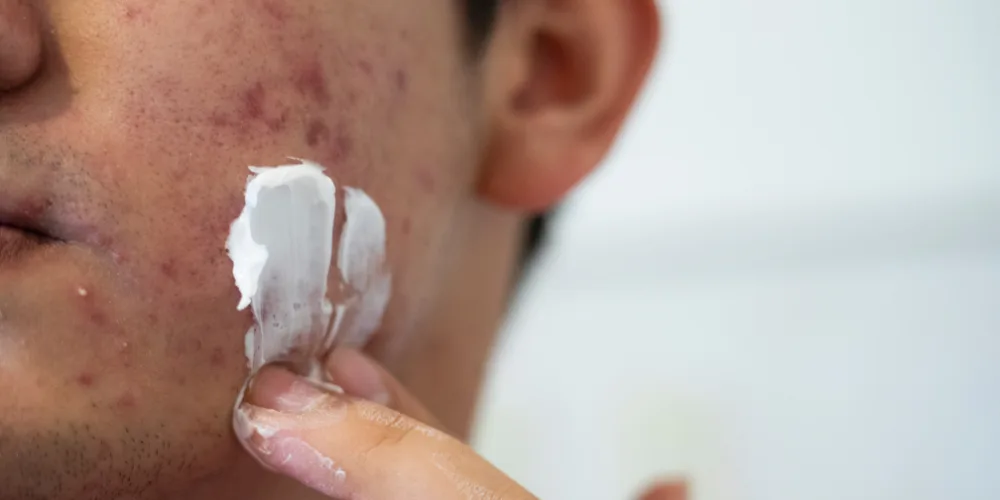 dermatologist recommended ingredients for acne prone skin - dr derrick phillips