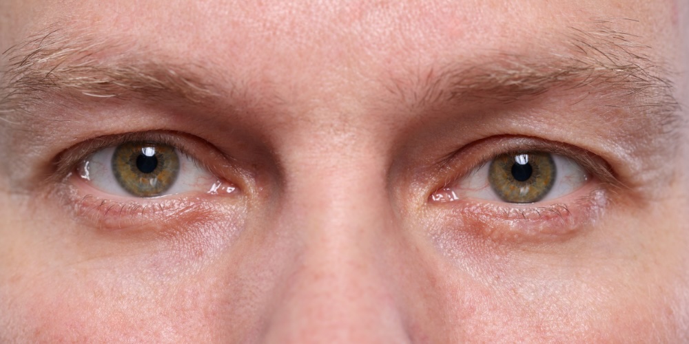 dark circles explained by a dermatologist