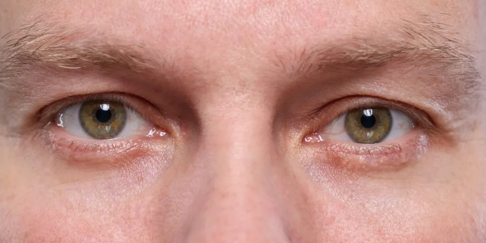 dark circles explained by a dermatologist