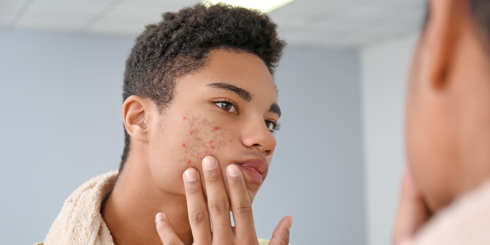 teenage acne skincare routine - dermatologist tips