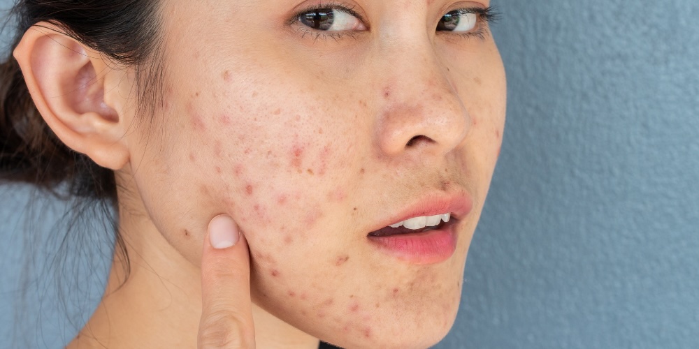 Spironolactone Treatment for Hormonal Acne in London