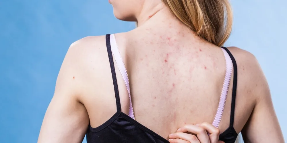 keloid acne scar treatment in london - dr derrick phillips