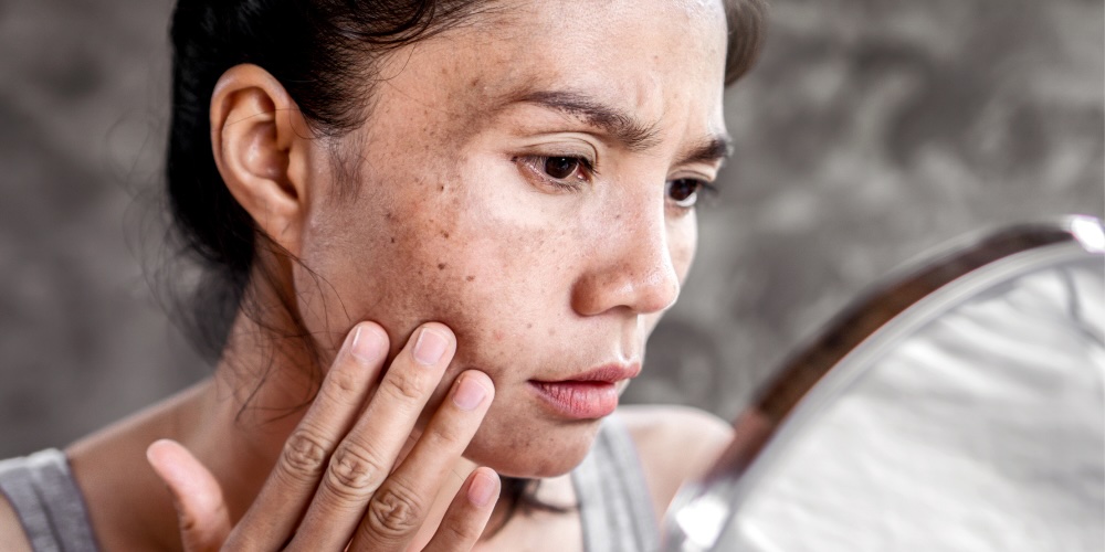 melasma treatment explained by a dermatologist - Tranexamic Acid