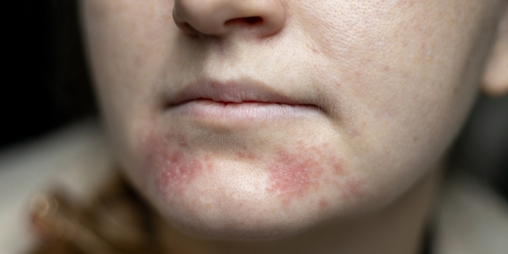 perioral dermatitis explained by a dermatologist - cuases and treatments