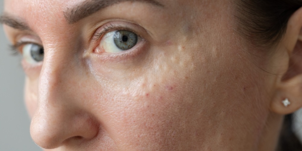 polynucleotide injections for dark circles under eyes - london, uk
