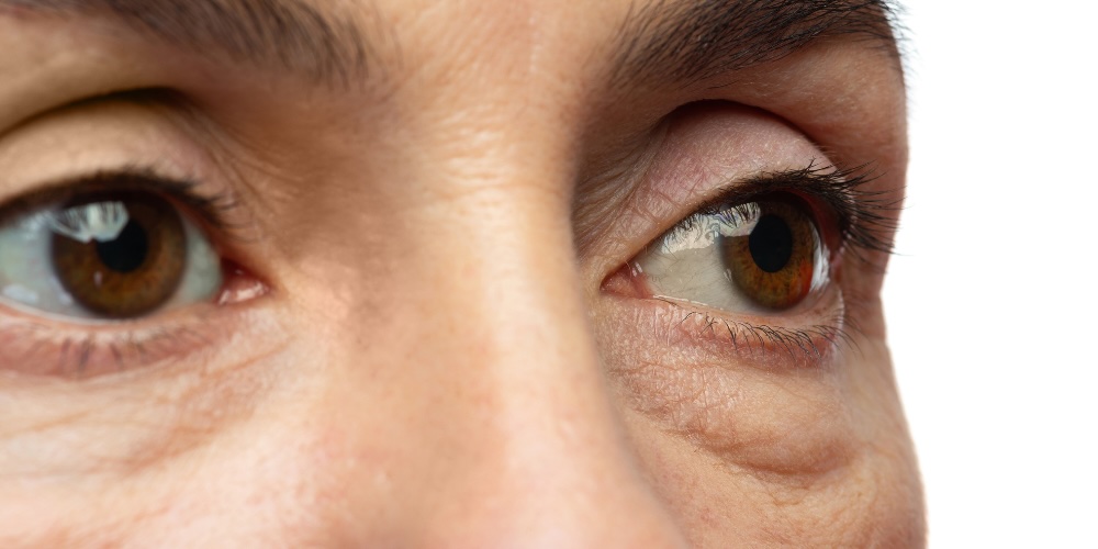 puffy dark circles - 5 causes of dark circles under the eye