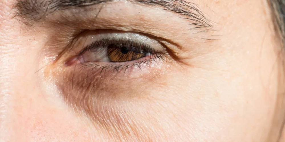 hollowing of the eye - causes of dark circles 