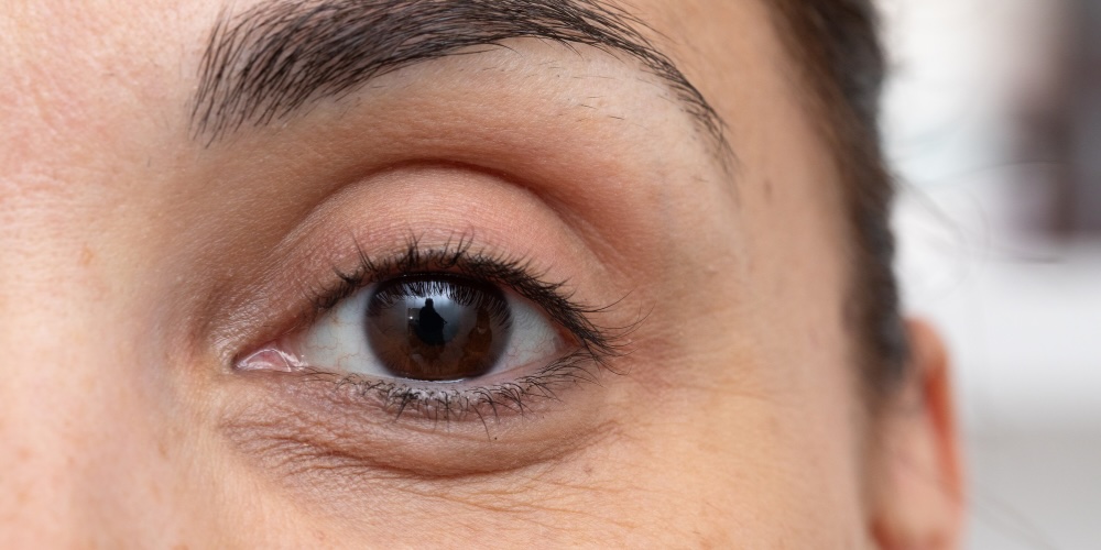 under eye dark circles - causes explained by dr derrick phillips