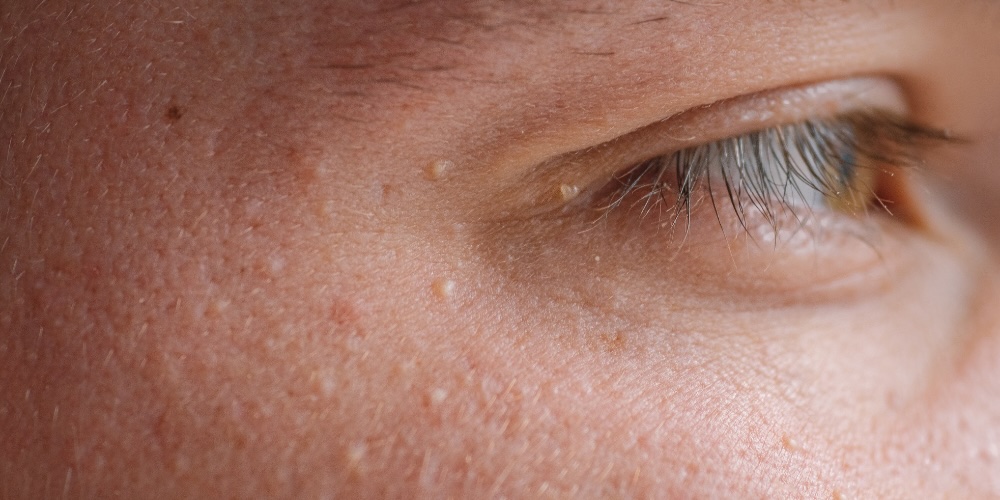 milia spot removal guide london - dr derrick phillips