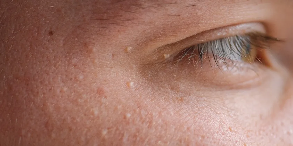 milia spot removal guide london - dr derrick phillips