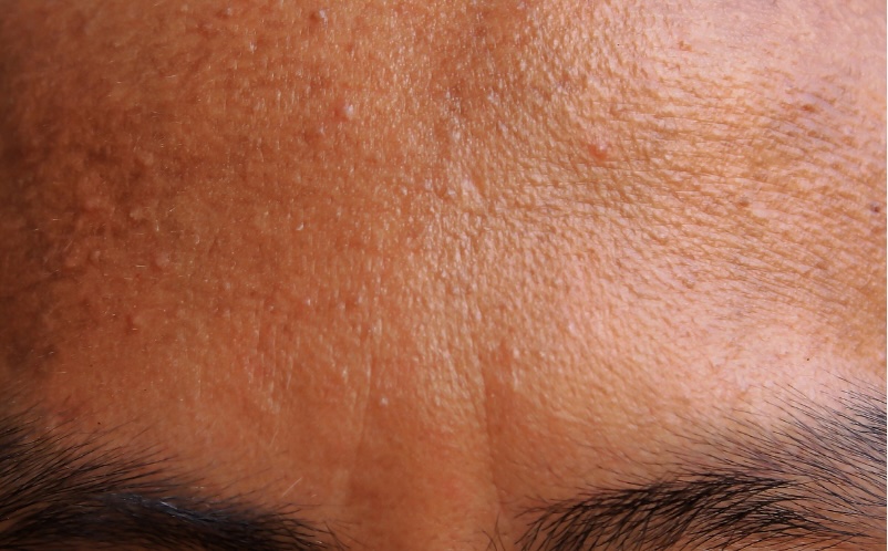 fungal acne treatment - London, UK dermatologist