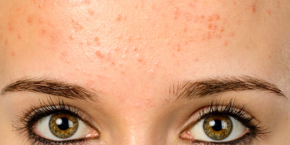 fungal acne treatment guide - dermatologist approved