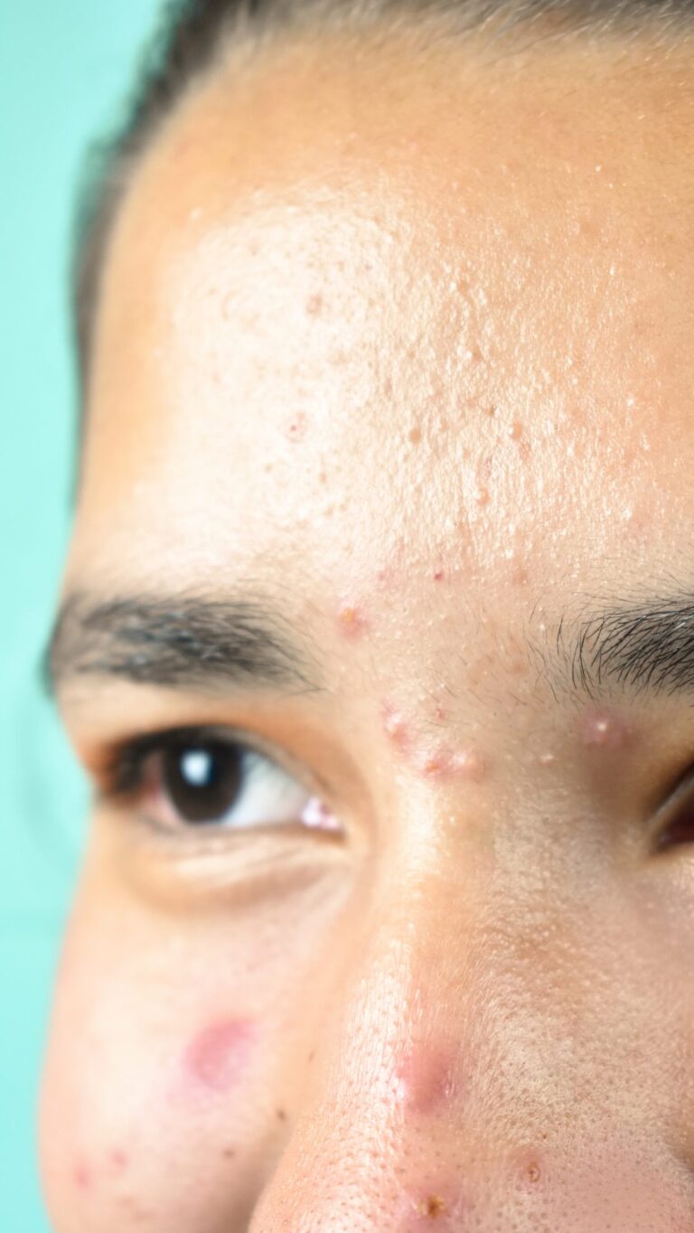 fungal acne treatment in the UK - dr derrick phillips