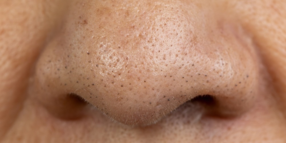 how to get rid of blackheads - london dermatologist explains
