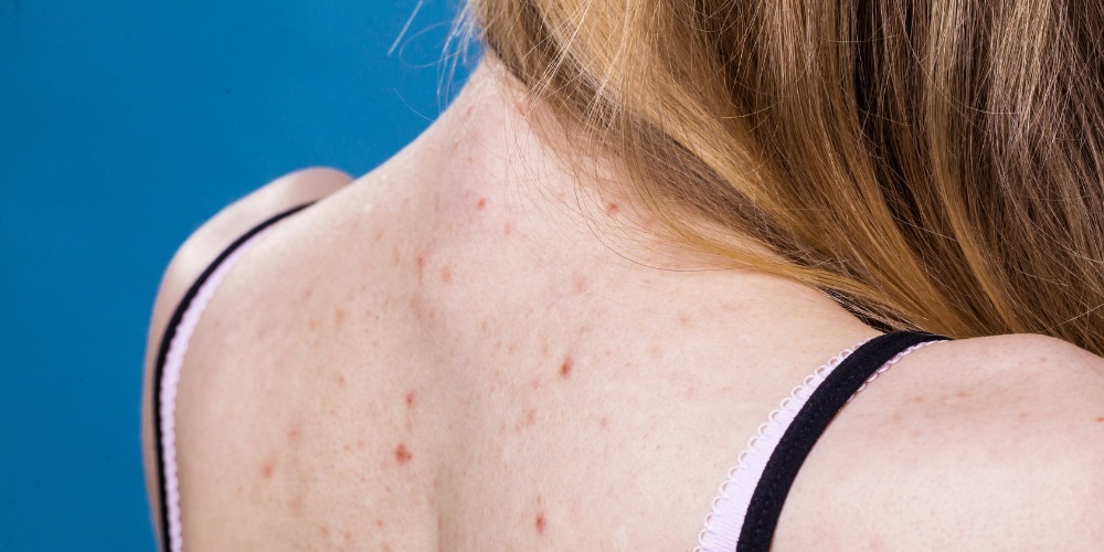 back acne treatment guide - get rid of bacne for good