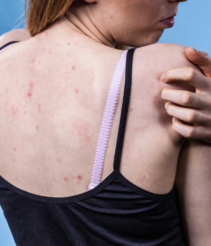 get rid of bacne - dermatologist treatment for back acne
