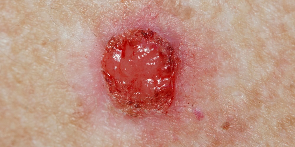 bcc skin cancer - bleeding spot