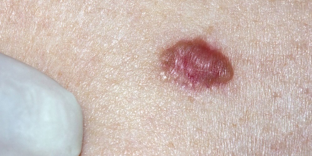 basal cell carcinoma image - pearly appearance