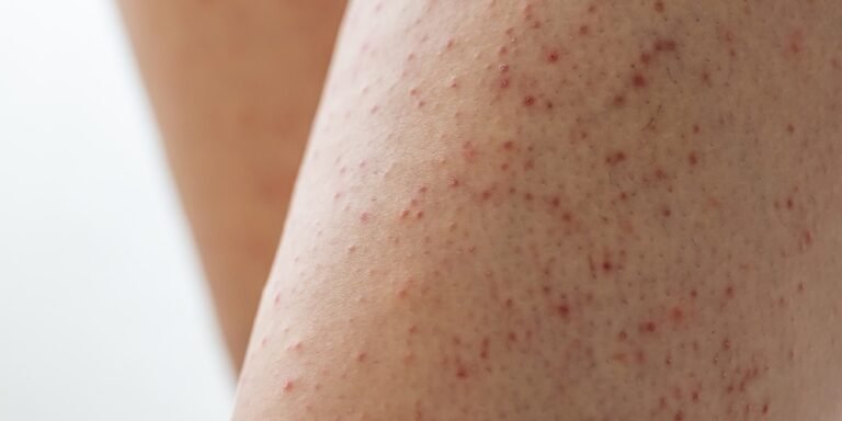 keratosis pilaris - strawberry legs