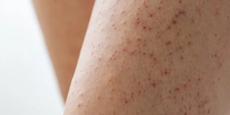 keratosis pilaris - strawberry legs