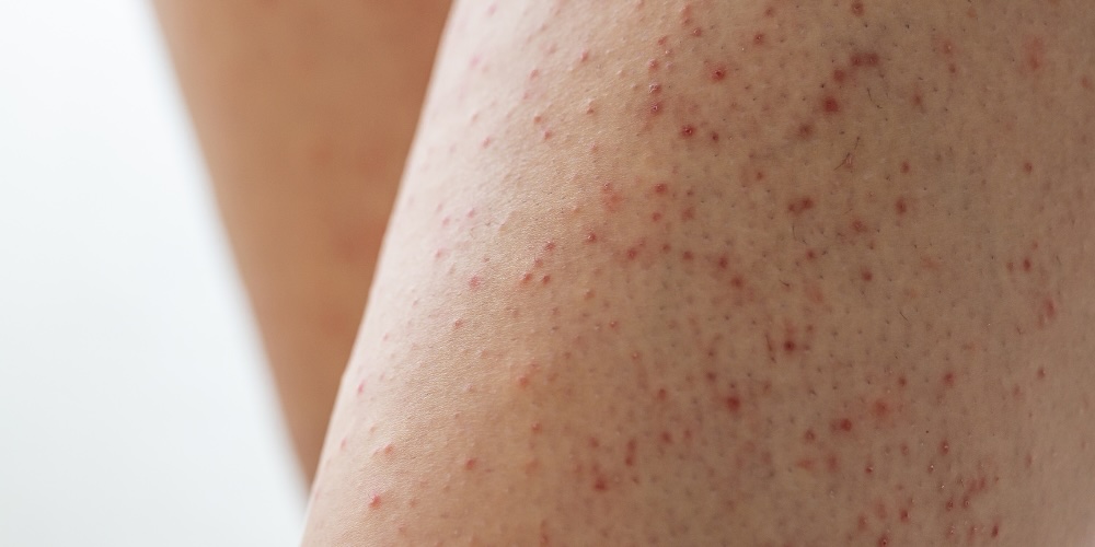 Keratosis Pilaris - treating strawberry legs