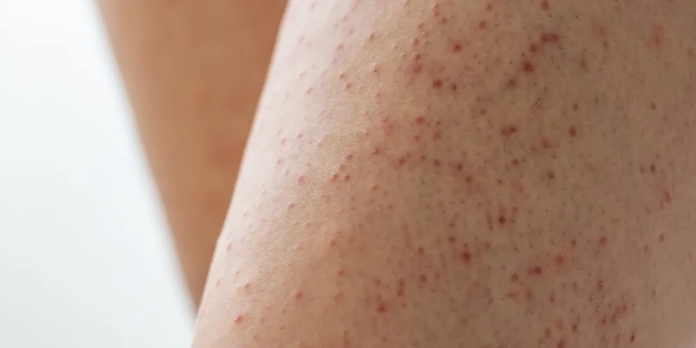 Keratosis Pilaris - treating strawberry legs