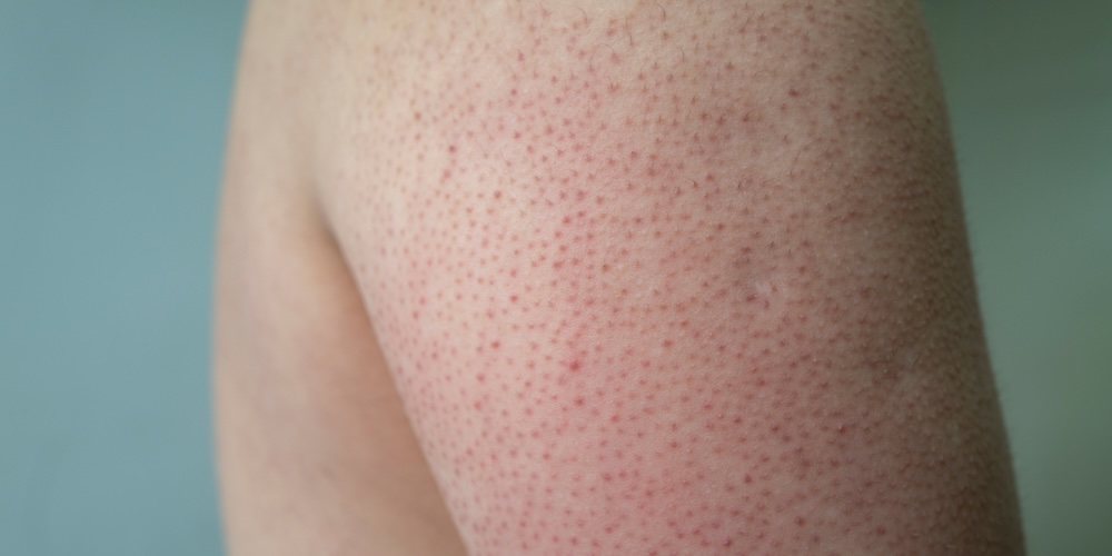 Keratosis Pilaris - treating chicken skin on arms